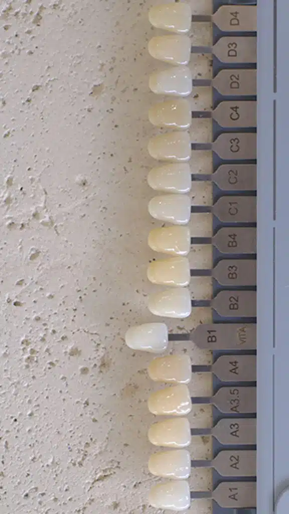 Choosing a tooth shade during cosmetic dental treatment at Gentle Dentistry of Poway