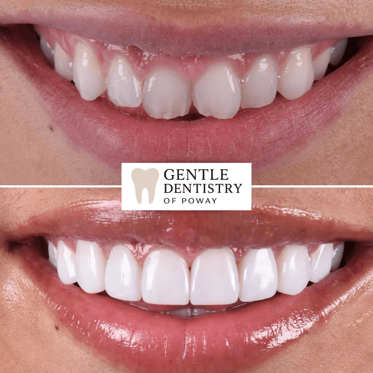 Invisalign before and after — patient 1, Poway CA