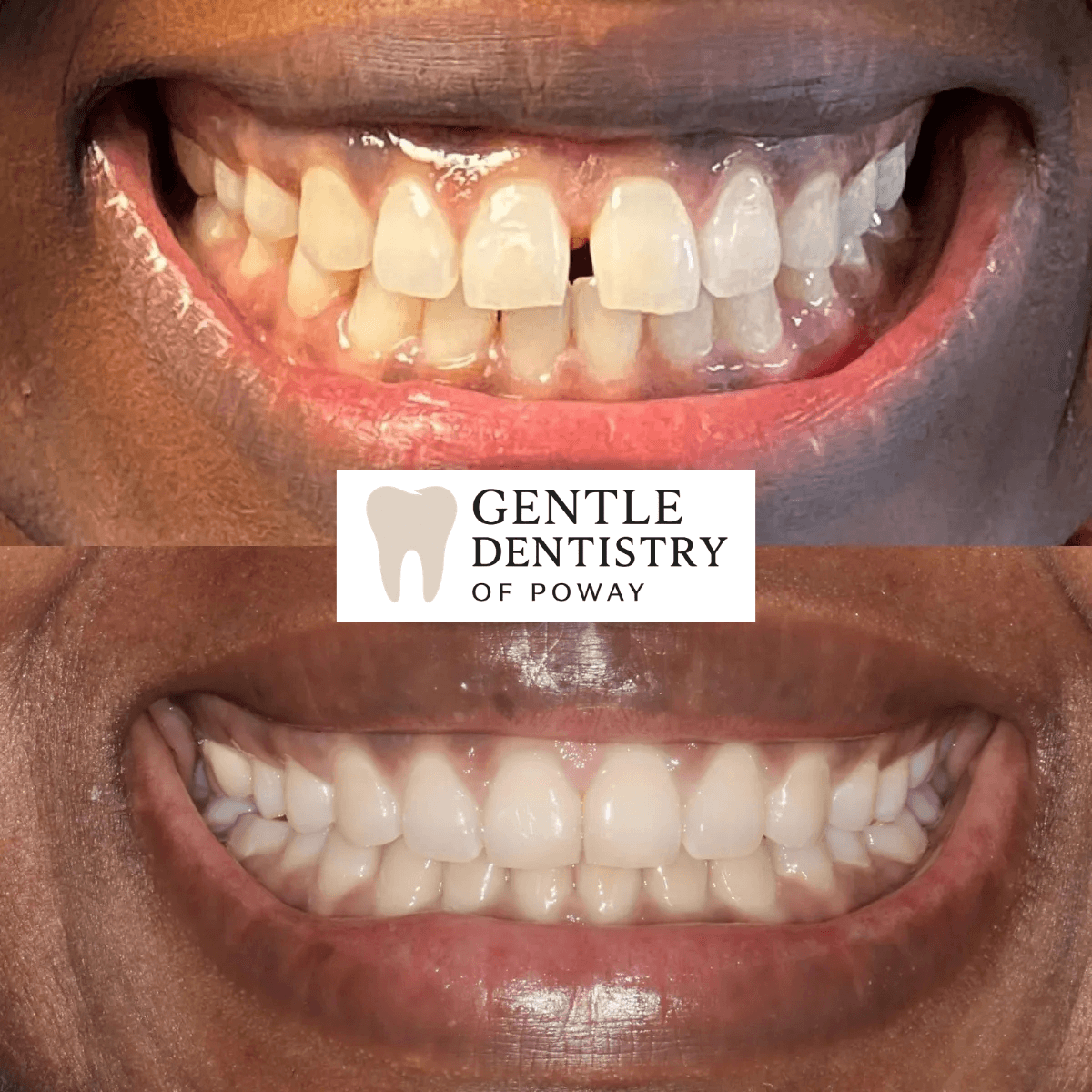 Invisalign before and after — patient 2, Poway CA