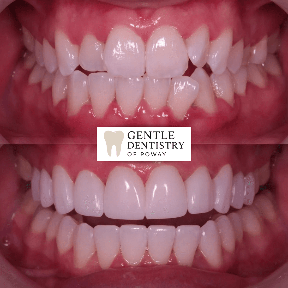 Invisalign before and after — patient 3, Poway CA
